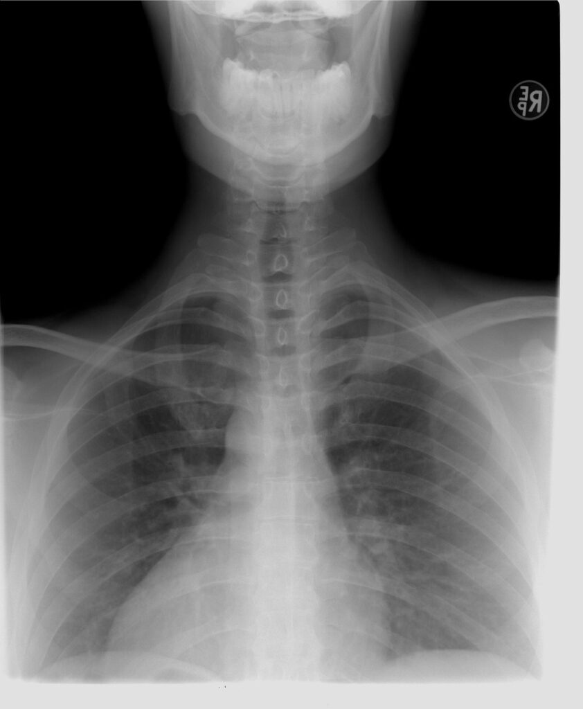 xray, thoracic spine, diagnosis